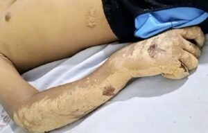 Adolescente com duas fraturas aguarda transferência para Teixeira de Freitas; falta de ortopedista no hospital de Itanhém pode agravar o quadro